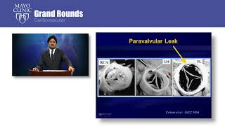 CV Grand Rounds – Transcatheter Aortic Valve Replacement [upl. by Dnalyar]