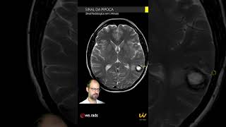 SINAL DA PIPOCA  Cavernoma na Ressonância Magnética do Encéfalo [upl. by Chaves111]