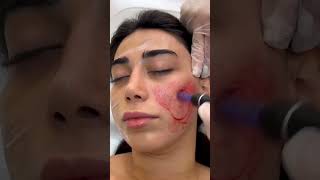 MEDİKUS KLİNİK  KOSMETOLOJİ  DERMATOLOJİ PROSEDURLAR [upl. by Hendrick]