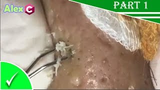 How to removal blackheads and whiteheads Pimple Popping Skincare [upl. by Taub]