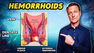 The 1 Best Remedy for Hemorrhoids  Dr Berg [upl. by Gunar]