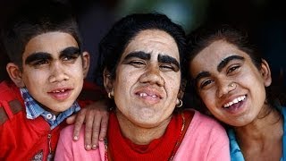 Nepalese werewolf family transformed by laser hair removal treatment [upl. by Yzdnil280]