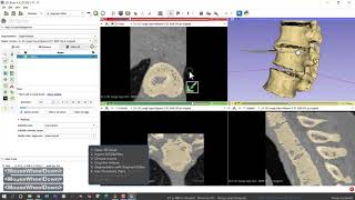 CT or MRI to 3D print DICOM to STL with Local computer Part 1 of 2 [upl. by Nimaj]