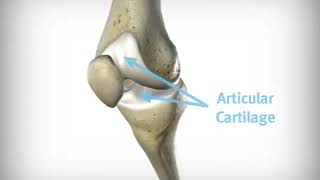 Gonartrosis Artrosis de Rodilla Evolución Zimmer Biomet®  SurgicalNet  IQ [upl. by Yornoc]