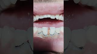 Composite restoration for anterior teethdentist dentista dental teeth dentistteeth [upl. by Eceinaj]