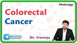 14 Colorectal Cancer  USMLE Step 1 Pathology 🩺💊🔬 [upl. by Tarsus]