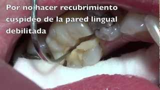 fractura dentaria [upl. by Colburn]