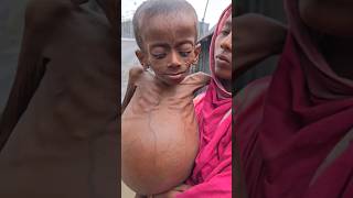 kwashiorkor  क्वाशियोकोर  Protein Deficiency  malnutrition [upl. by Lodnar598]