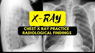 Chest X Ray Practice 37  Radiological Findings Bronchitis [upl. by Martella451]