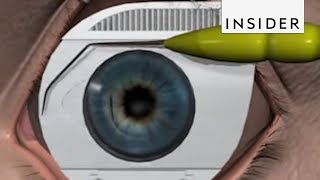 How LASIK Eye Surgery Is Performed [upl. by Noiek]