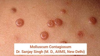 Molluscum Contagiosum by Dr Sanjay Singh M D AIIMS New Delhi Molluscum skincare skin [upl. by Frey]