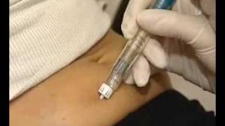 How correctly use multidose GONAL  F injection [upl. by Enitsuj]