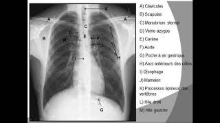 le visible et linvisible sur une radiographie thoracique [upl. by Felicie625]