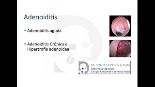 4 Adenoiditis [upl. by Anegal]