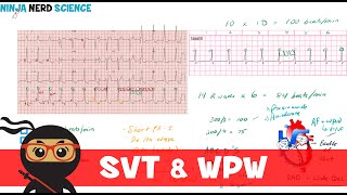 Rate and Rhythm  Supraventricular Tachycardia SVT and WolffParkinsonWhite WPW Syndrome [upl. by Lakin125]