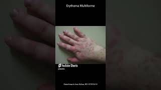 Erythema Multiforme [upl. by Silvana7]