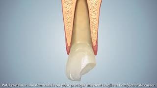 les Couronnes dentaires sur une dent sur plusieurs sur implant [upl. by Berget]