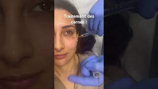 Traitement des cernes par acidehyaluronique raspaldo regard medecineesthetique [upl. by Nedac]