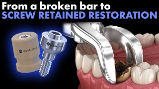 From a broken bar to screw retained restoration Digital impression by Uniqa Dental [upl. by Nednal941]