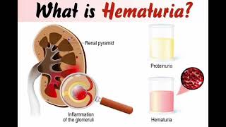 Haematuria Red urine mrcpch Clinical [upl. by Eynttirb848]