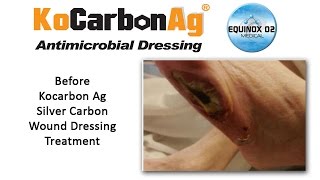 KoCarbon Ag Silver Wound Dressing  Case Study  Left Lateral Foot Ulcer Video [upl. by Latashia]