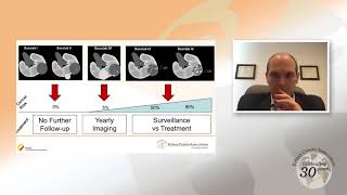 Small Renal Masses An Overview [upl. by Akienaj]