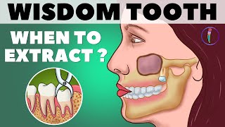 Wisdom Teeth Removal  When to extract Wisdom teeth Third molar  Animation  Medinaz [upl. by Ecnerret]