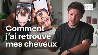 Les greffes de cheveux séduisent de plus en plus face à la calvitie  RTS [upl. by Gent908]