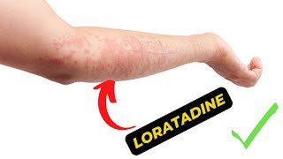 What is Loratadine Used For A Comprehensive Guide to Its Uses and Benefits [upl. by Hallette]