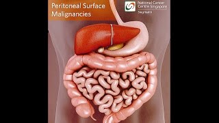 All About Peritoneal Tumours Causes Symptoms Diagnosis and Treatment [upl. by Peggir]