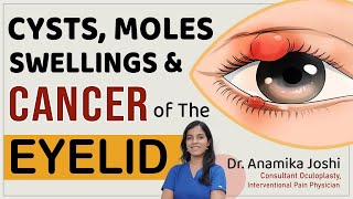 What are these swellings around the eye   Eyelid  Swellings on eyelid  Dr Anamika Joshi [upl. by Eillib20]