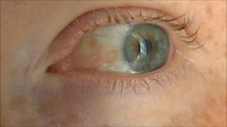 Episcleritis a benign inflammatory eye condition before and after treatment [upl. by Dede]