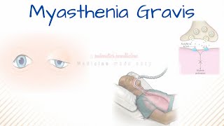 MYASTHENIA GRAVIS  Pathophysiology Causes Diagnosis Treatment [upl. by Vandyke]