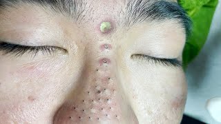 Big Cystic Acne Blackheads Extraction Blackheads amp Milia Whiteheads Removal Pimple Popping  3047 [upl. by Erinn]