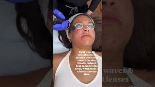 Picosure Laser picosure lasertreatment picosurelaser antiaging medspa hyperpigmentation [upl. by Meenen]