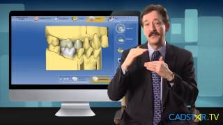 Parameters Impacting Occlusion for CEREC Bluecam and Omnicam [upl. by Romito]