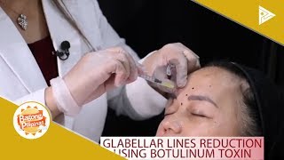 DERMAESTHETIQUE Glabellar lines reduction [upl. by Adiesirb31]