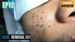 Cystic Acne Extraction 30mn  Blackheads Removal by ACNEREMOVAL101 [upl. by Anavlis]