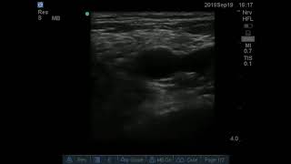 Ultrasound guided Obturator Nerve Block [upl. by Ennaehr302]