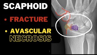 Anatomical Snuff box Part 2 Scaphoid  Fracture AVN  In 3 MINUTES [upl. by Otir612]