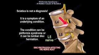 Piriformis Syndrome and Sciatica [upl. by Nydnarb]