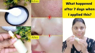 I used Vitamin C Serum 7 days👆🏻This is what happened Tight glowing fair skin for uneven Dull skin [upl. by Sochor]