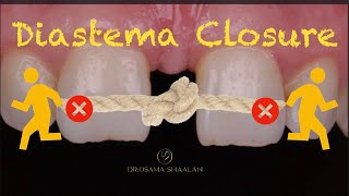 Diastema closure using direct bonding  front wing technique [upl. by Deny]