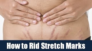 How to Rid Stretch Marks [upl. by Ytineres523]