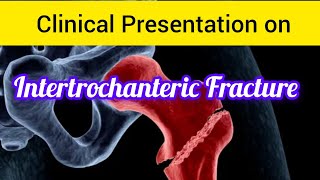 Clinical Presentation on Intertrochanteric Fracture ncpfracturecasecasestudy [upl. by Rand]