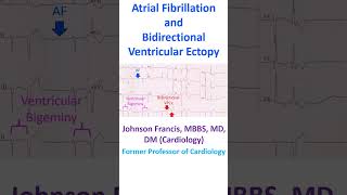 Atrial Fibrillation and Bidirectional Ventricular Ectopy [upl. by Hamaso]