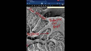 Kidney pathology part 1 [upl. by Gualtiero]