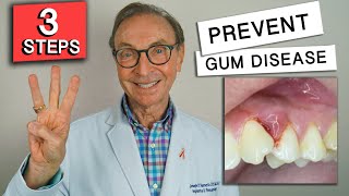 3 Easy Ways to Prevent Gum Disease at Home [upl. by Namie]