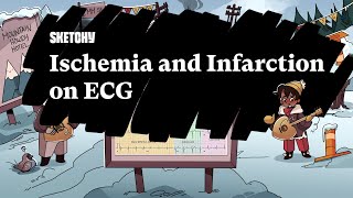 Ischemia amp Infarction on ECG Part 1  Sketchy Medical  USMLE Step 2 CK [upl. by Yacano354]