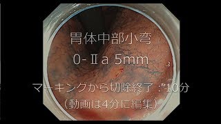 消化器内科『胃 ESD（内視鏡的粘膜下層剥離術）』4分編集動画 [upl. by Ressler]